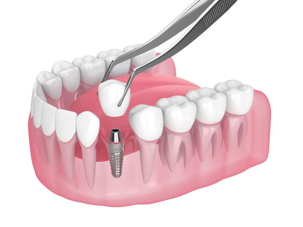 Dental Implant Restorations in Durham