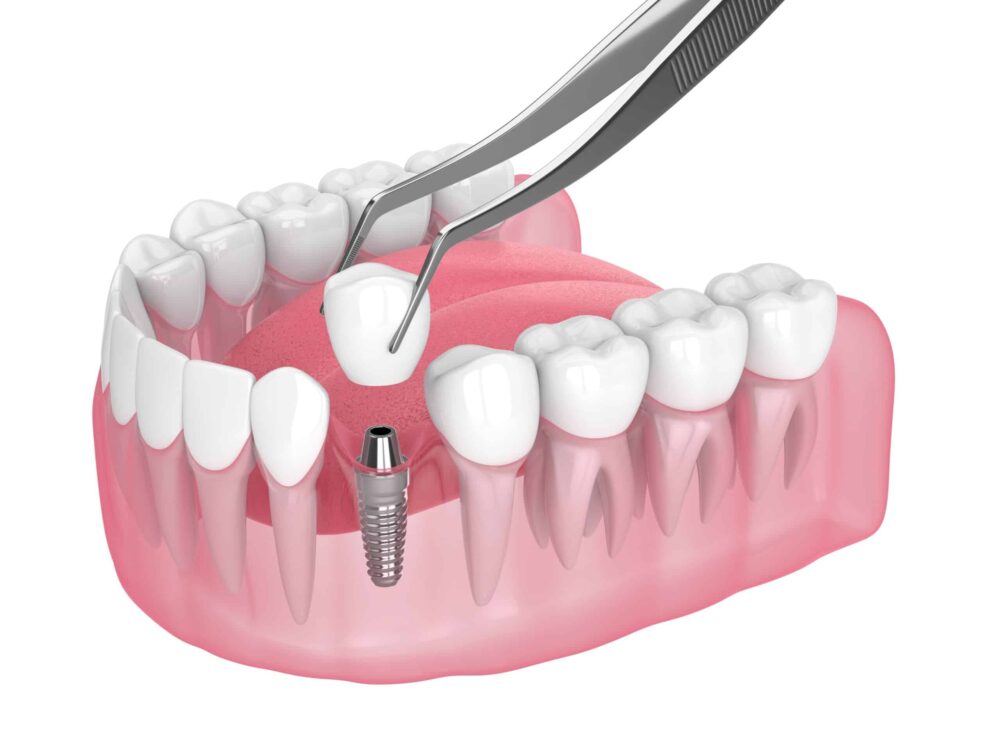 Dental Implant Restorations in Durham