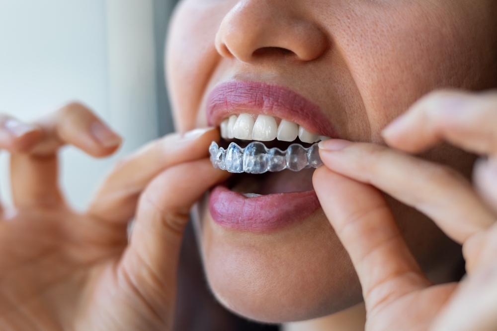 Invisalign