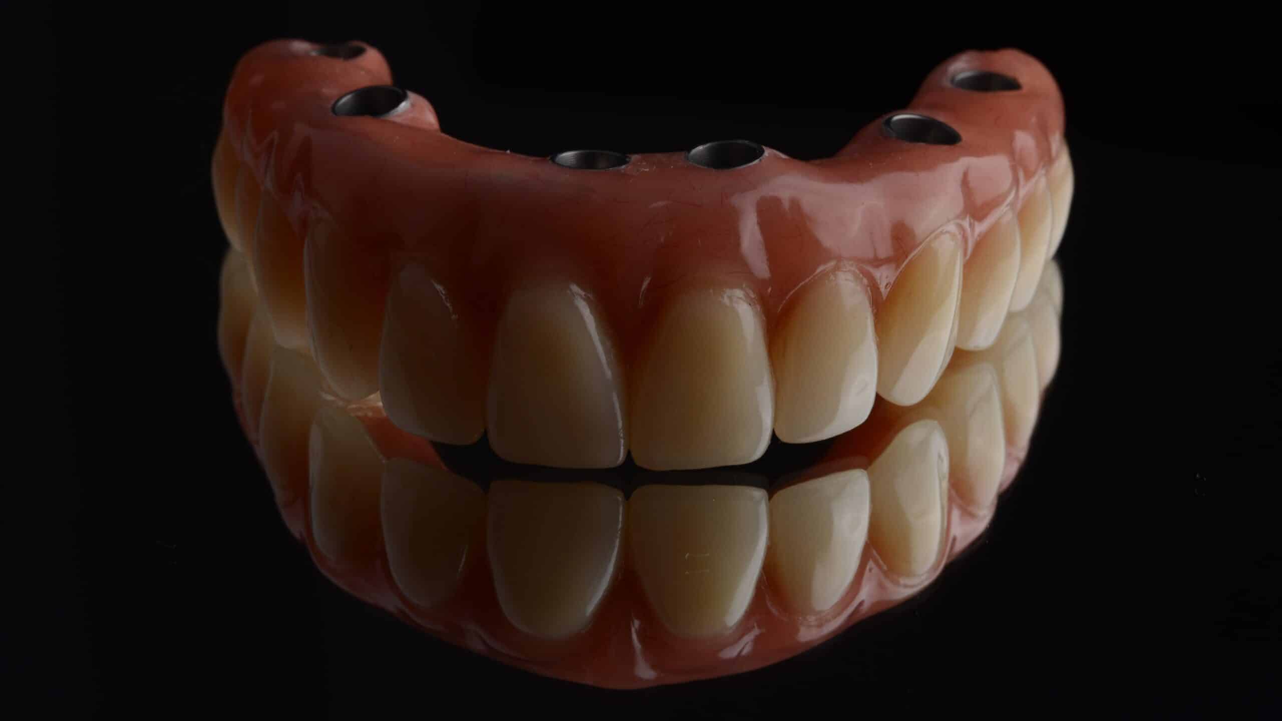 Implant-Retained Dentures durham