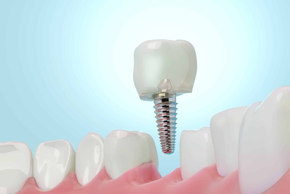 Single-Tooth Implant Restorations durham
