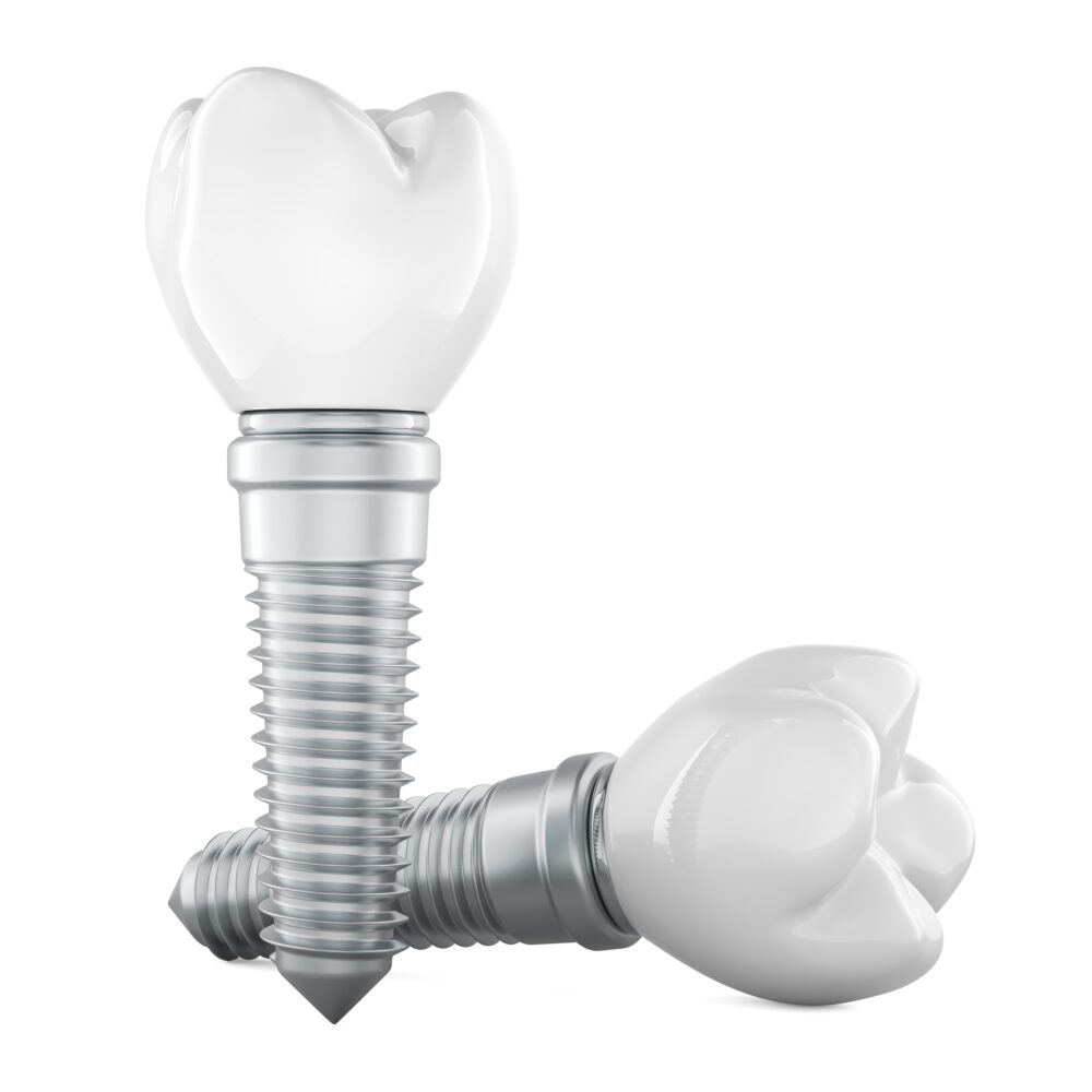 Single-Tooth Implant Restorations durham